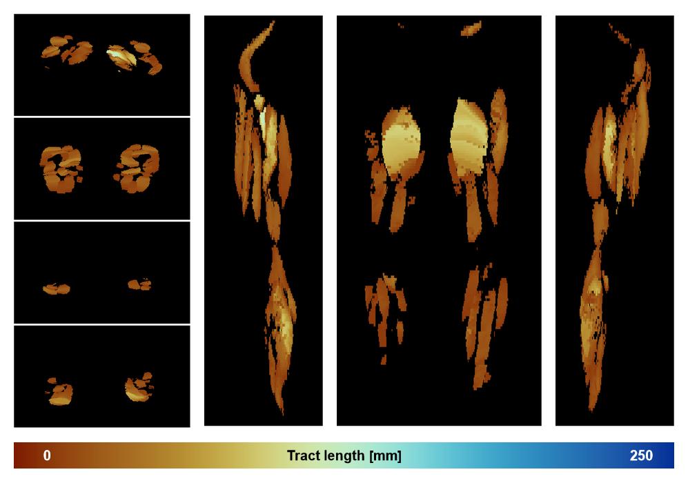 Muscle fiber tract length map based on whole leg DTI based fiber tractography.