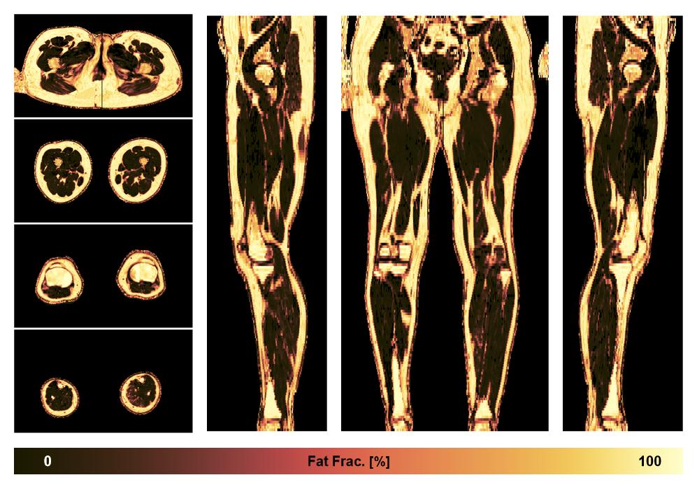 The fat fraction of the lower extremity obtained from the dixon reconstruction for muscle water fat quantification.