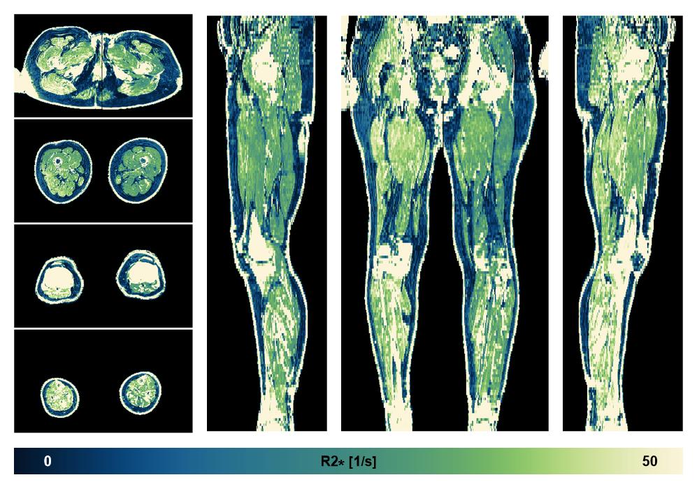 The R2 star relaxation time of the lower extremity obtained from the dixon reconstruction for muscle water fat quantification.