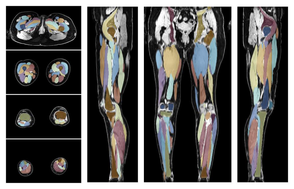 Overlay of automated muscle segmentation labels on dixon water image.