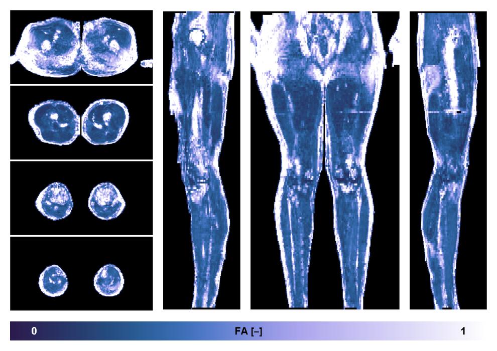 IVIM corrected whole leg muscle fractional anisotropy obtained from diffusion tensor imaging.