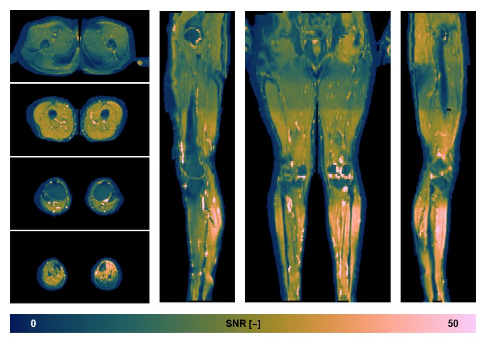 SNR distribution of the unweighted diffusion data.