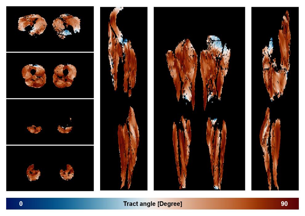 Muscle fiber tract angle map based on whole leg DTI based fiber tractography.