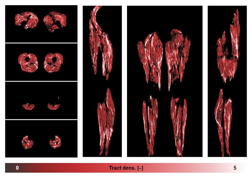 Muscle fiber tract density map based on whole leg DTI based fiber tractography.