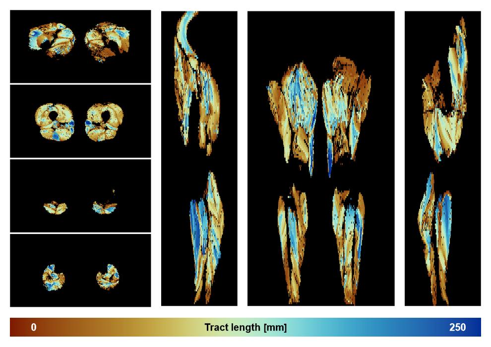 Muscle fiber tract length map based on whole leg DTI based fiber tractography.