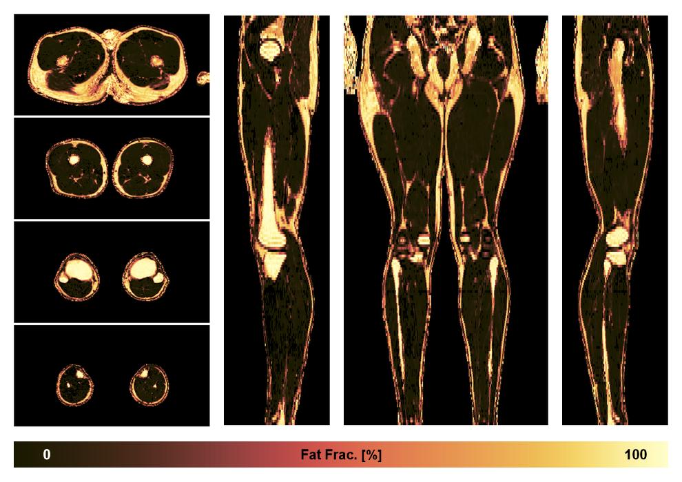 The fat fraction of the lower extremity obtained from the dixon reconstruction for muscle water fat quantification.