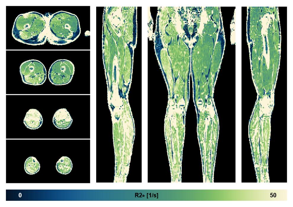 The R2 star relaxation time of the lower extremity obtained from the dixon reconstruction for muscle water fat quantification.