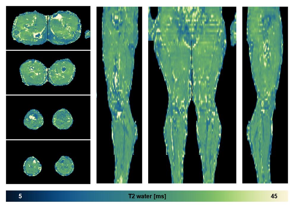The water only T2 relaxation time of the lower extremity obtained from multi echo spin echo t2 mapping with EPG based reconstruction.