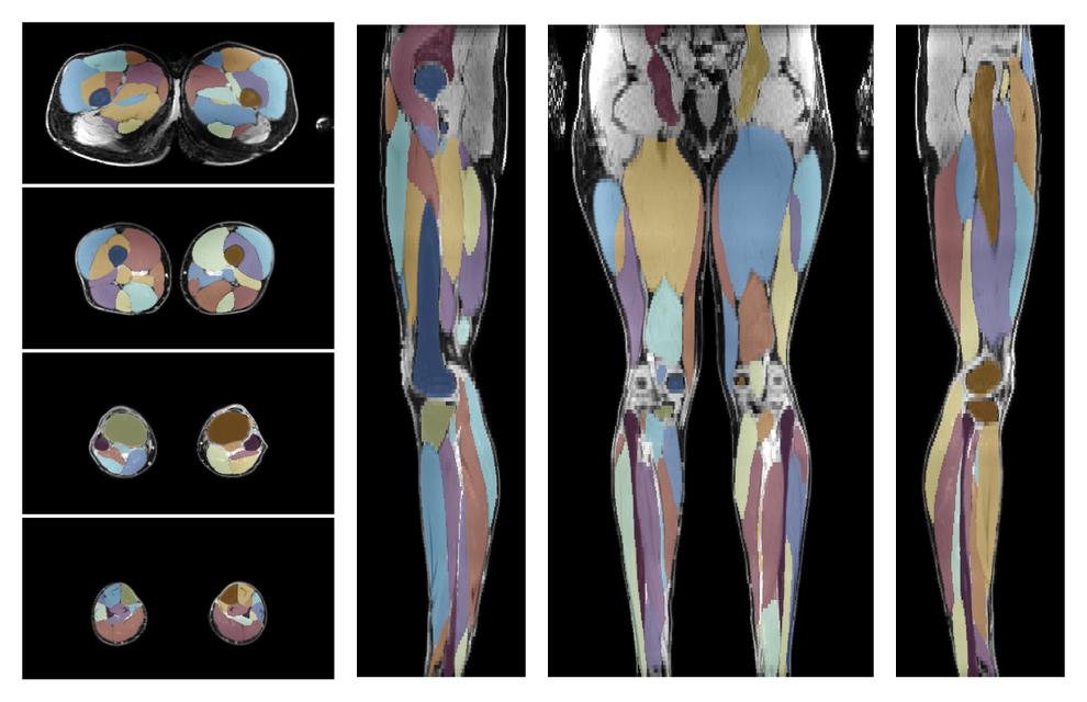 Overlay of automated muscle segmentation labels on dixon water image.