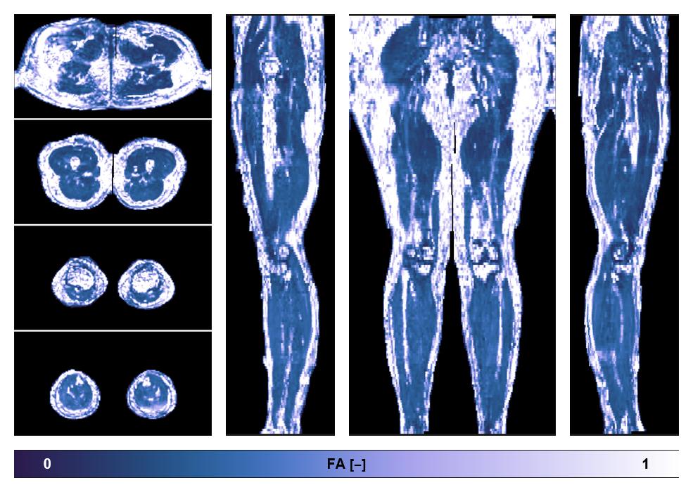IVIM corrected whole leg muscle fractional anisotropy obtained from diffusion tensor imaging.