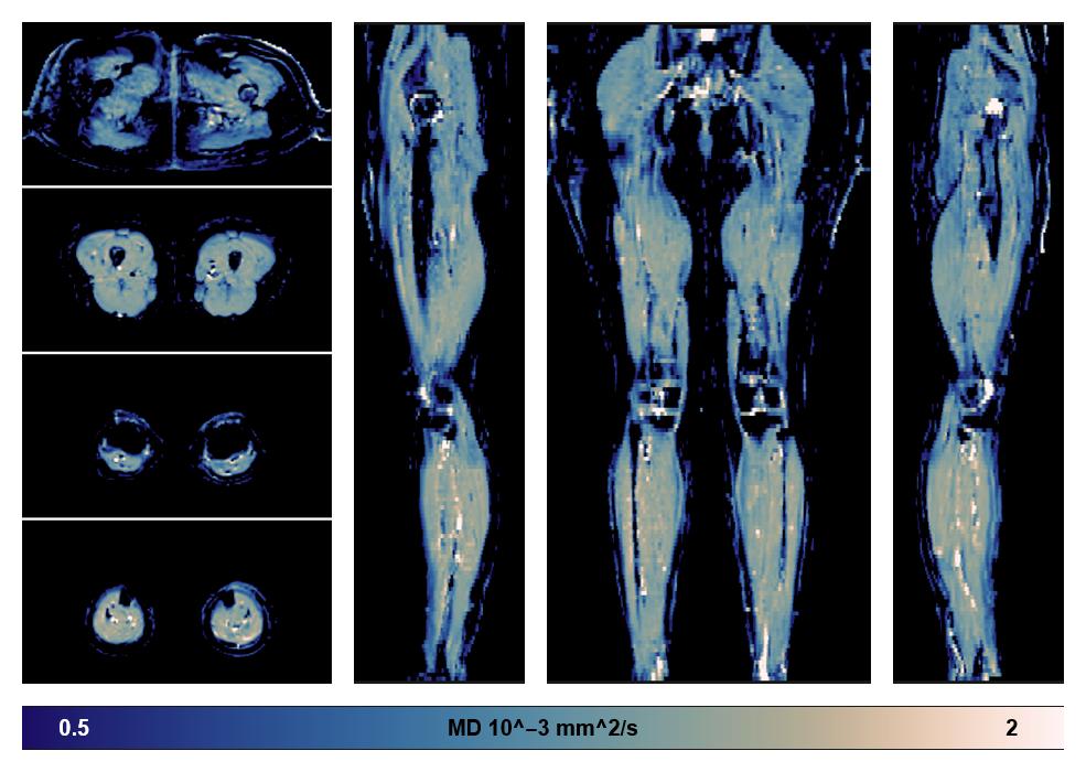 IVIM corrected whole leg muscle mean diffusivity obtained from diffusion tensor imaging.