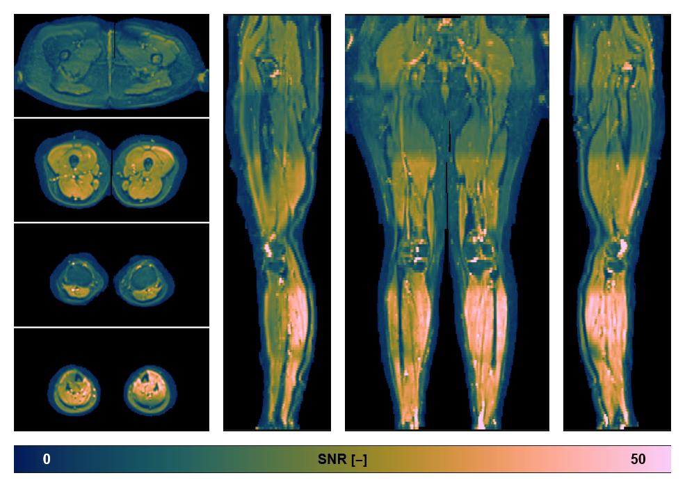 SNR distribution of the unweighted diffusion data.