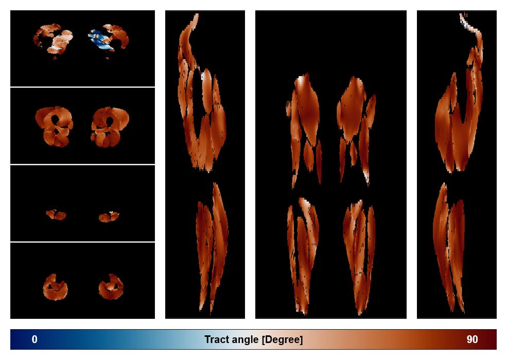 Muscle fiber tract angle map based on whole leg DTI based fiber tractography.