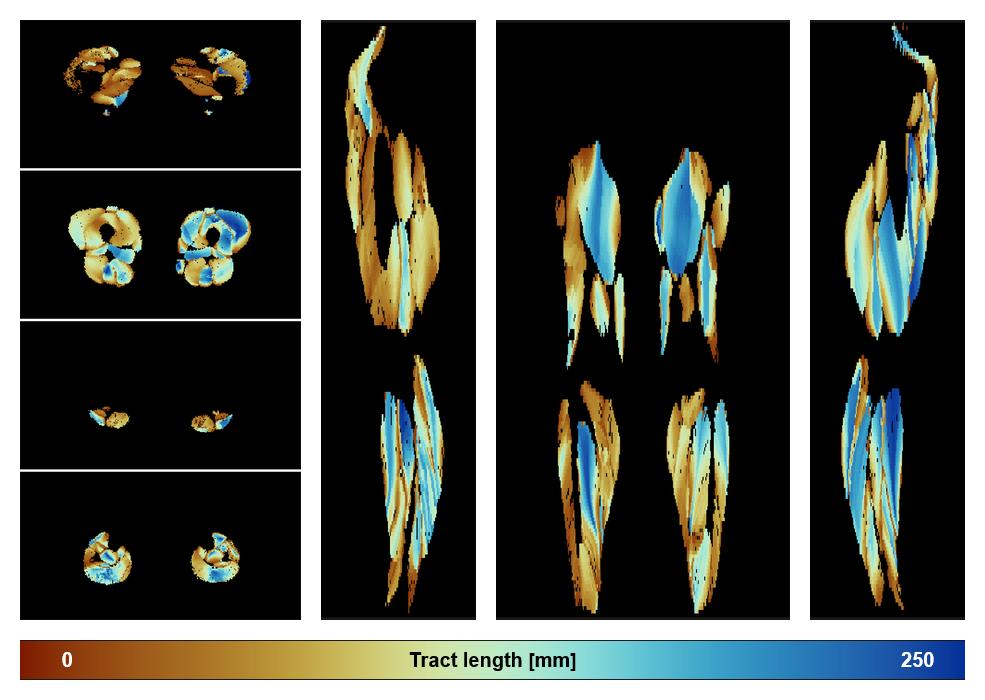 Muscle fiber tract length map based on whole leg DTI based fiber tractography.