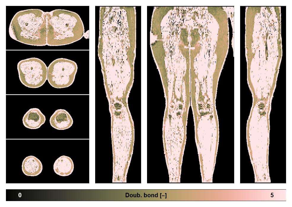 Number of double bonds in subcutanious fat.