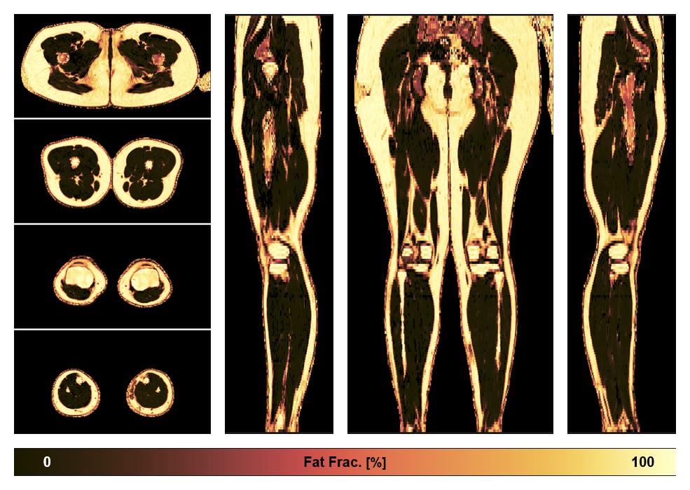 The fat fraction of the lower extremity obtained from the dixon reconstruction for muscle water fat quantification.
