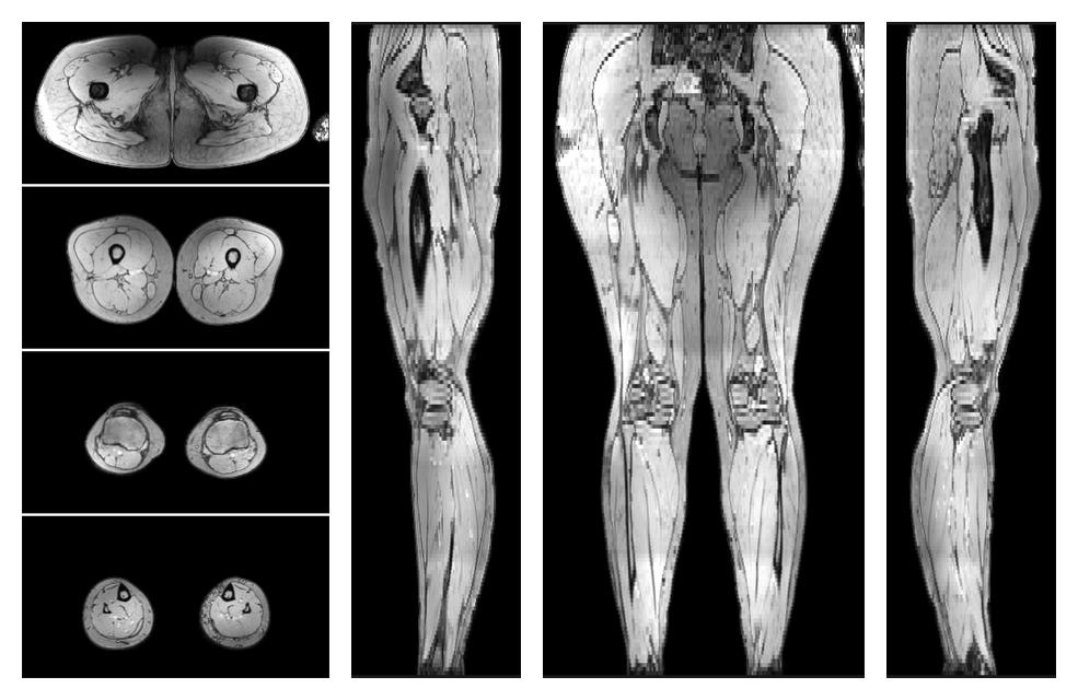 The out-phase image of the dixon reconstruction for water fat quantification.