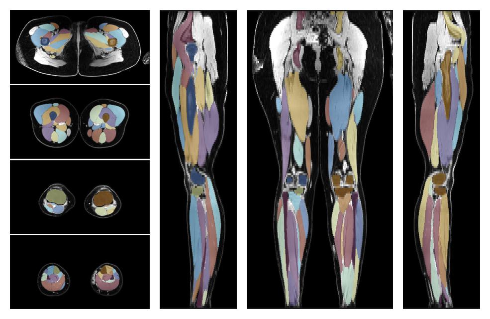 Overlay of automated muscle segmentation labels on dixon water image.