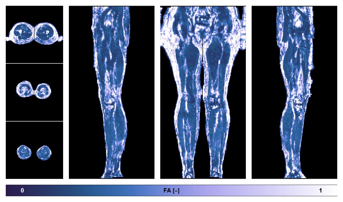 IVIM corrected whole leg muscle fractional anisotropy obtained from diffusion tensor imaging.