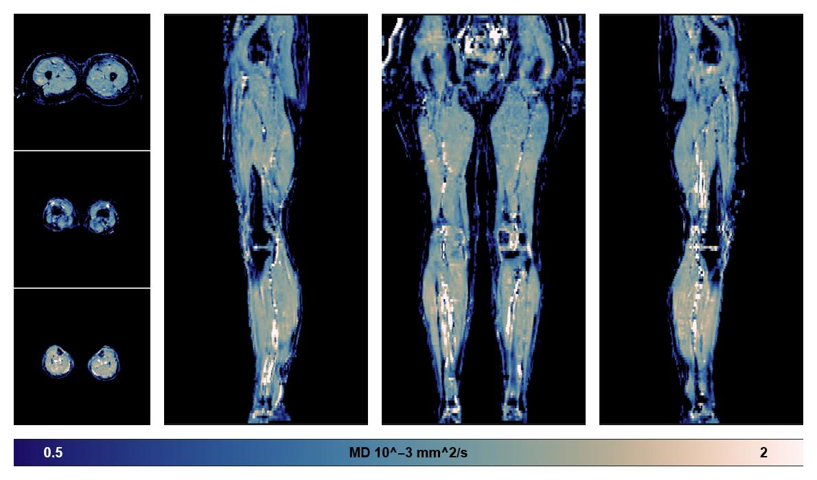 IVIM corrected whole leg muscle mean diffusivity obtained from diffusion tensor imaging.