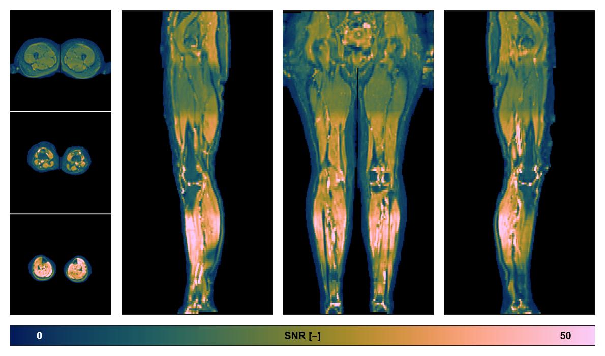 SNR distribution of the unweighted diffusion data.