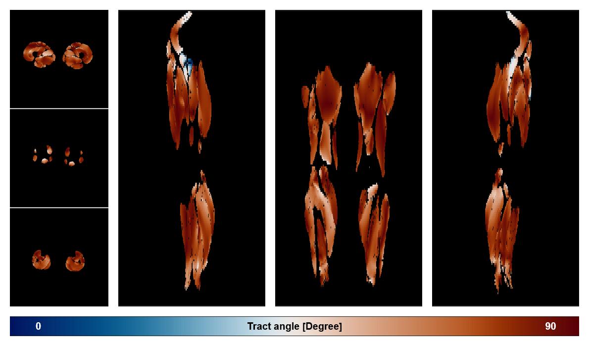 Muscle fiber tract angle map based on whole leg DTI based fiber tractography.