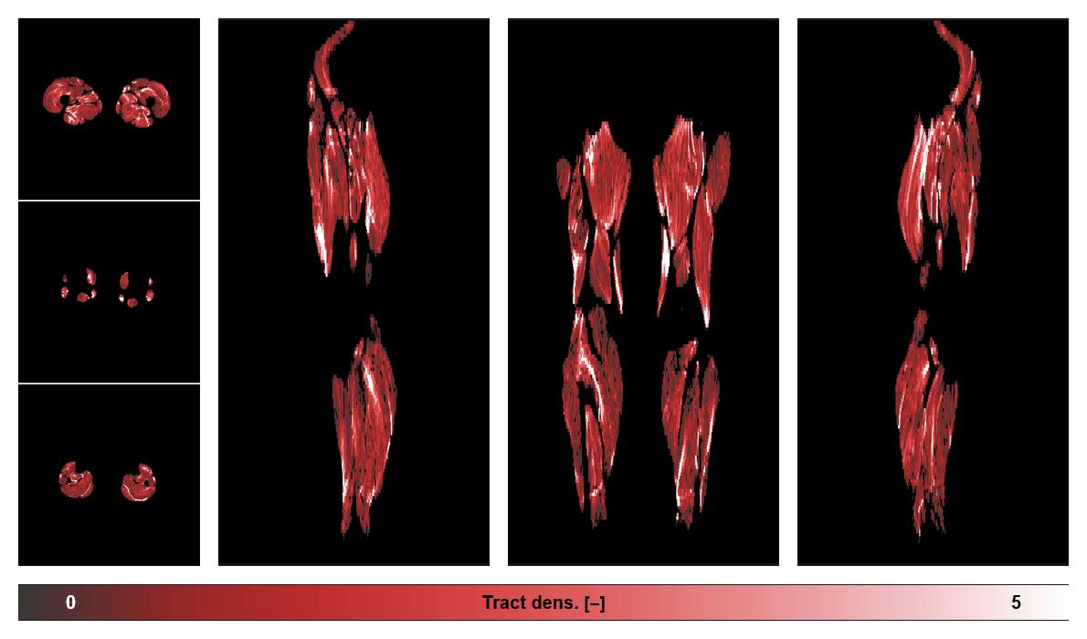 Muscle fiber tract density map based on whole leg DTI based fiber tractography.