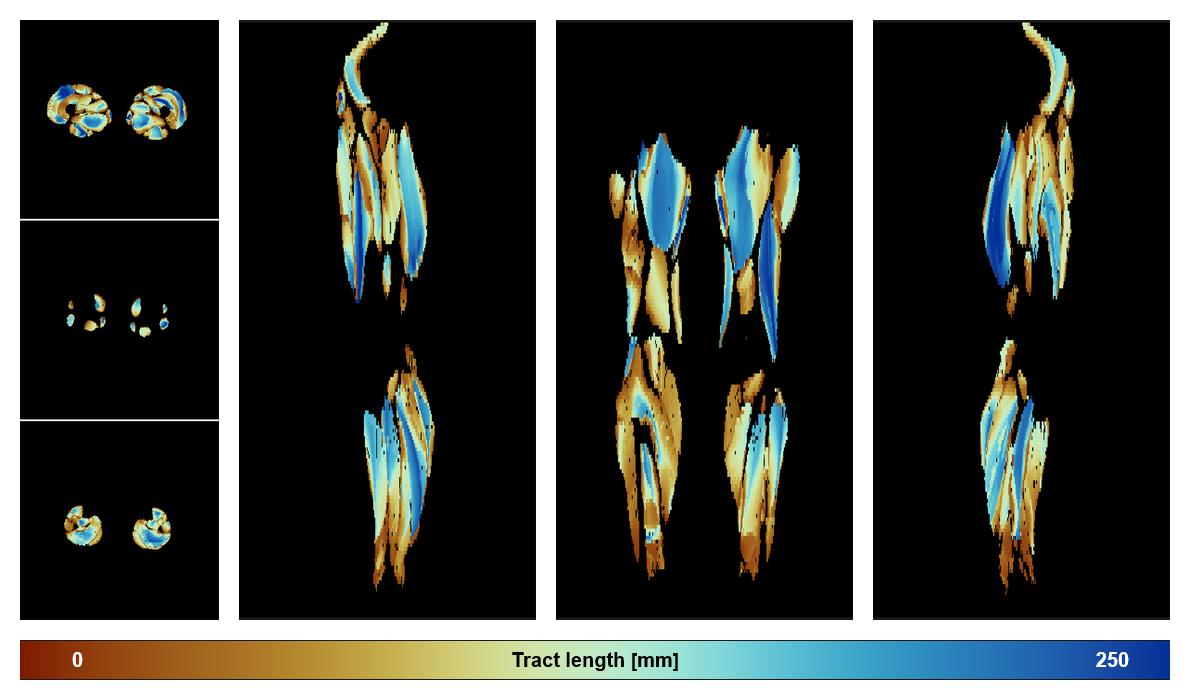 Muscle fiber tract length map based on whole leg DTI based fiber tractography.