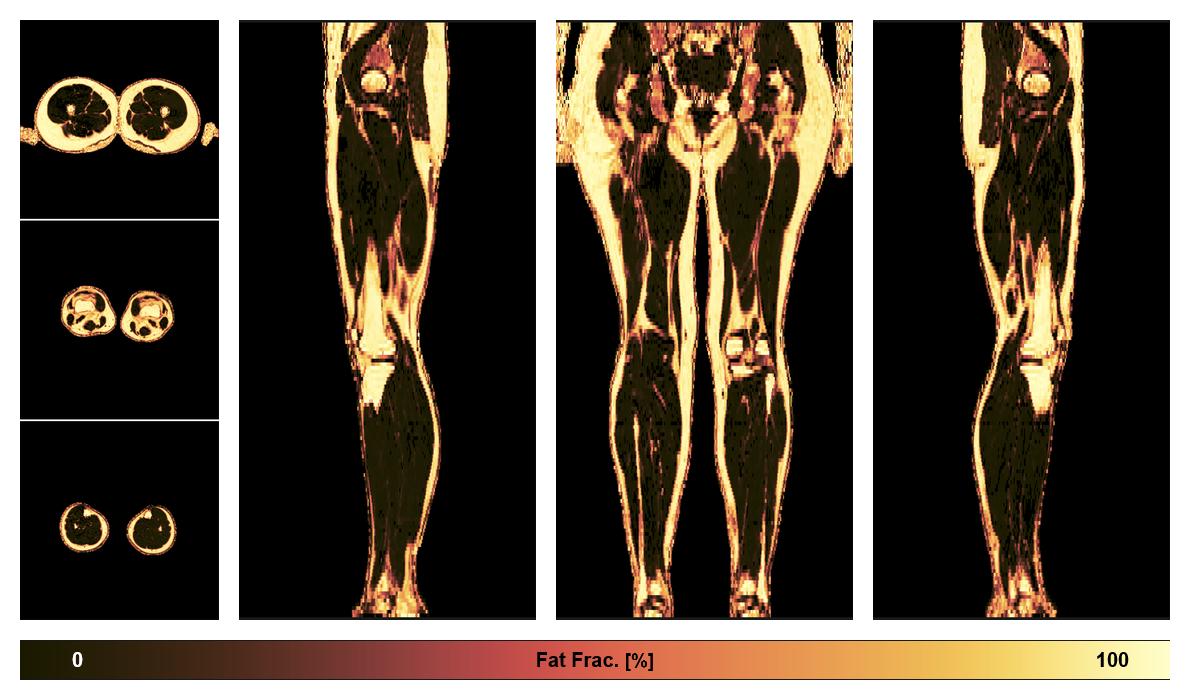 The fat fraction of the lower extremity obtained from the dixon reconstruction for muscle water fat quantification.