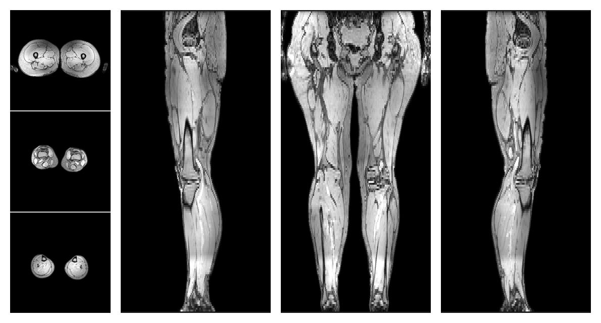 The out-phase image of the dixon reconstruction for water fat quantification.