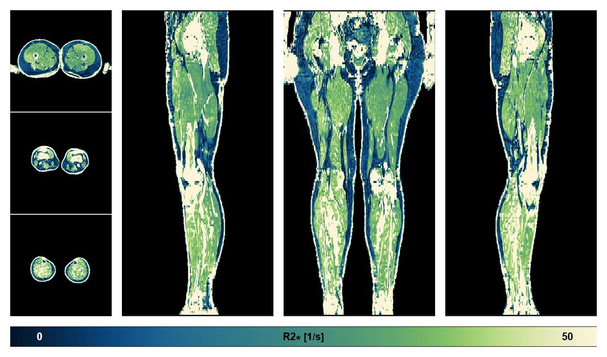 The R2 star relaxation time of the lower extremity obtained from the dixon reconstruction for muscle water fat quantification.