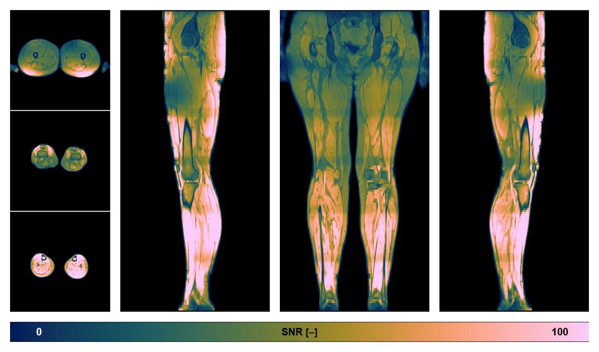 The SNR distribution of the dixon data.