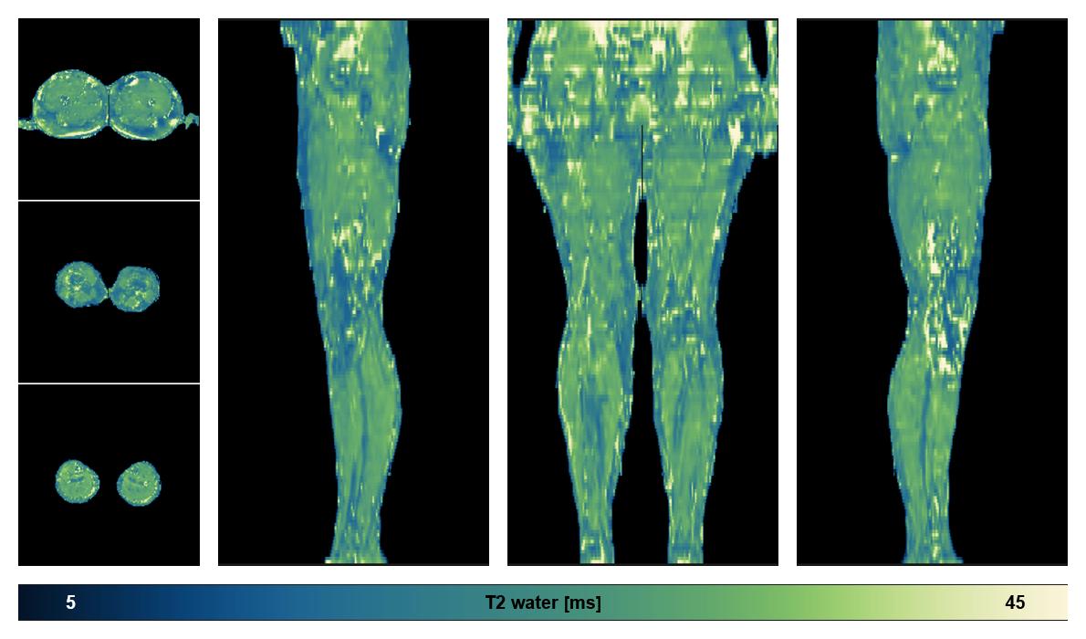 The water only T2 relaxation time of the lower extremity obtained from multi echo spin echo t2 mapping with EPG based reconstruction.