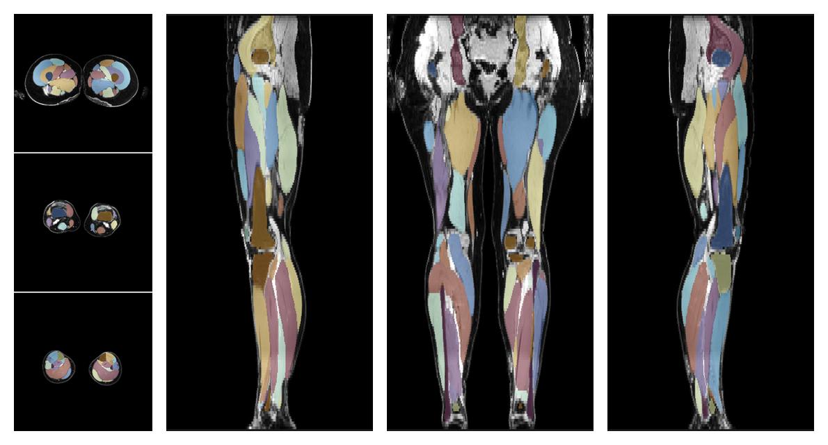Overlay of automated muscle segmentation labels on dixon water image.