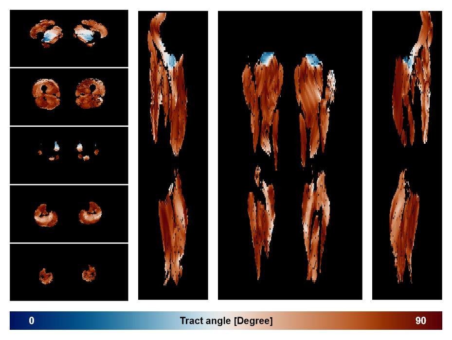 Muscle fiber tract angle map based on whole leg DTI based fiber tractography.