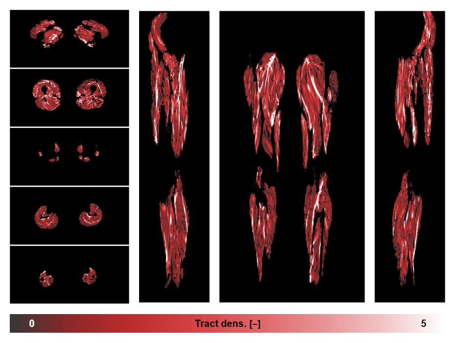 Muscle fiber tract density map based on whole leg DTI based fiber tractography.