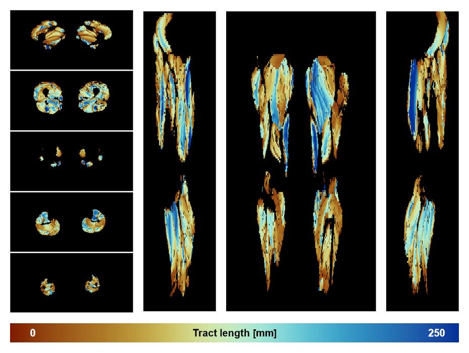 Muscle fiber tract length map based on whole leg DTI based fiber tractography.