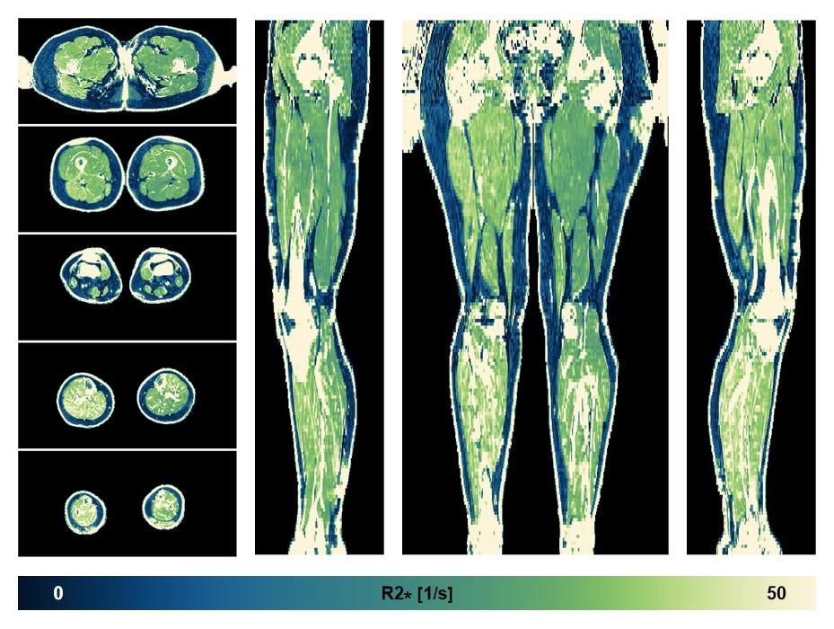 The R2 star relaxation time of the lower extremity obtained from the dixon reconstruction for muscle water fat quantification.