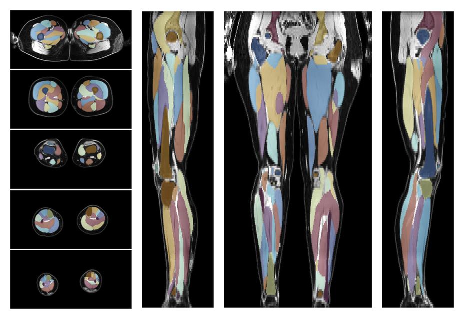 Overlay of automated muscle segmentation labels on dixon water image.