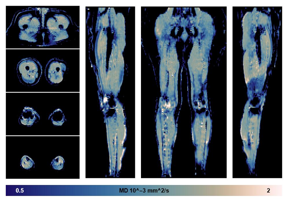 IVIM corrected whole leg muscle mean diffusivity obtained from diffusion tensor imaging.