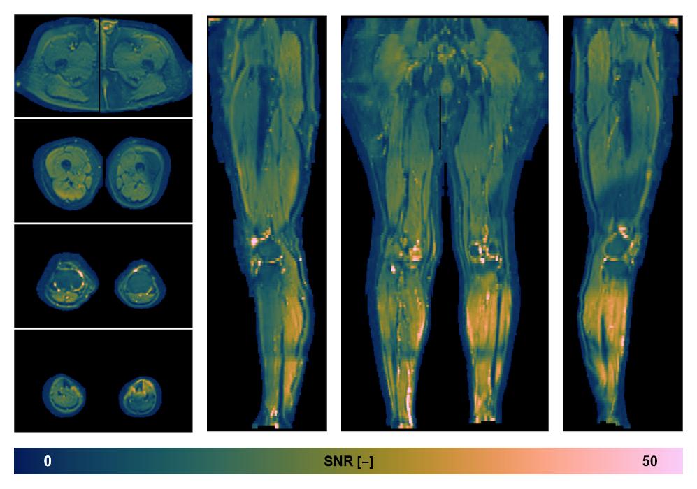 SNR distribution of the unweighted diffusion data.