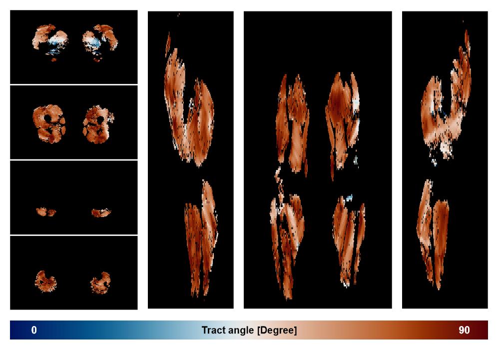 Muscle fiber tract angle map based on whole leg DTI based fiber tractography.