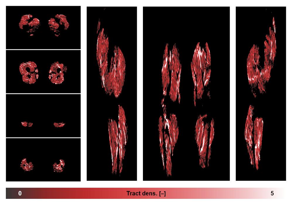 Muscle fiber tract density map based on whole leg DTI based fiber tractography.