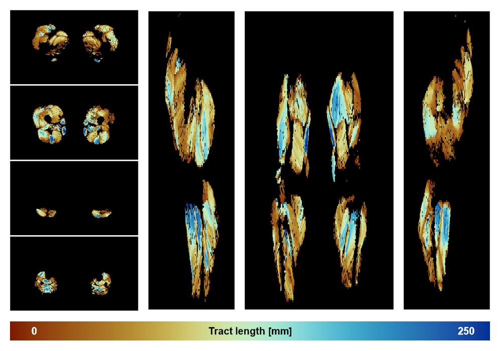 Muscle fiber tract length map based on whole leg DTI based fiber tractography.