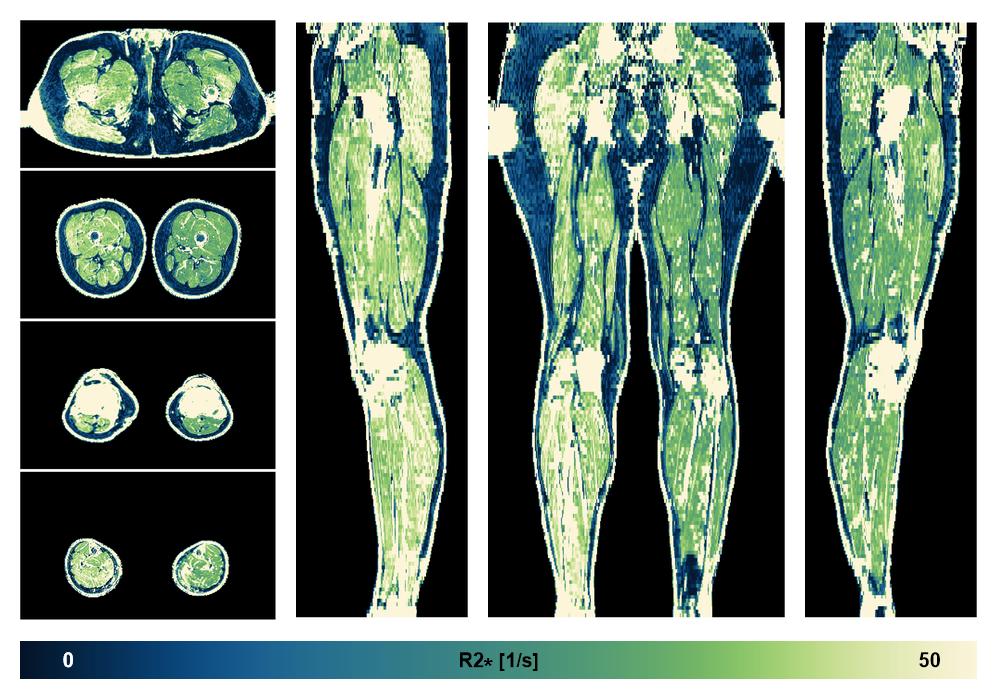 The R2 star relaxation time of the lower extremity obtained from the dixon reconstruction for muscle water fat quantification.