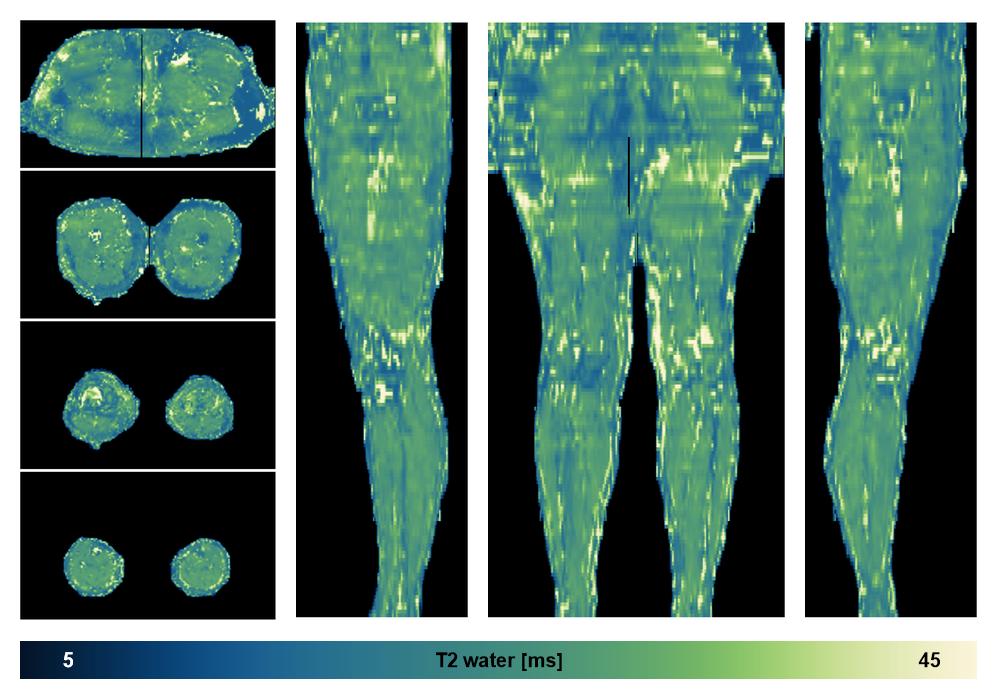 The water only T2 relaxation time of the lower extremity obtained from multi echo spin echo t2 mapping with EPG based reconstruction.