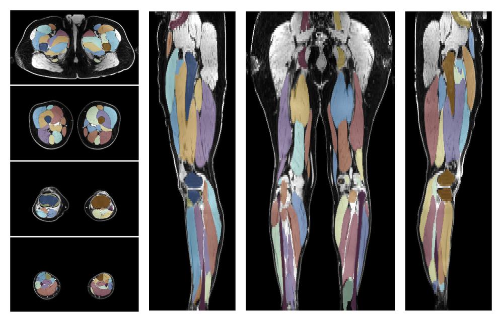 Overlay of automated muscle segmentation labels on dixon water image.