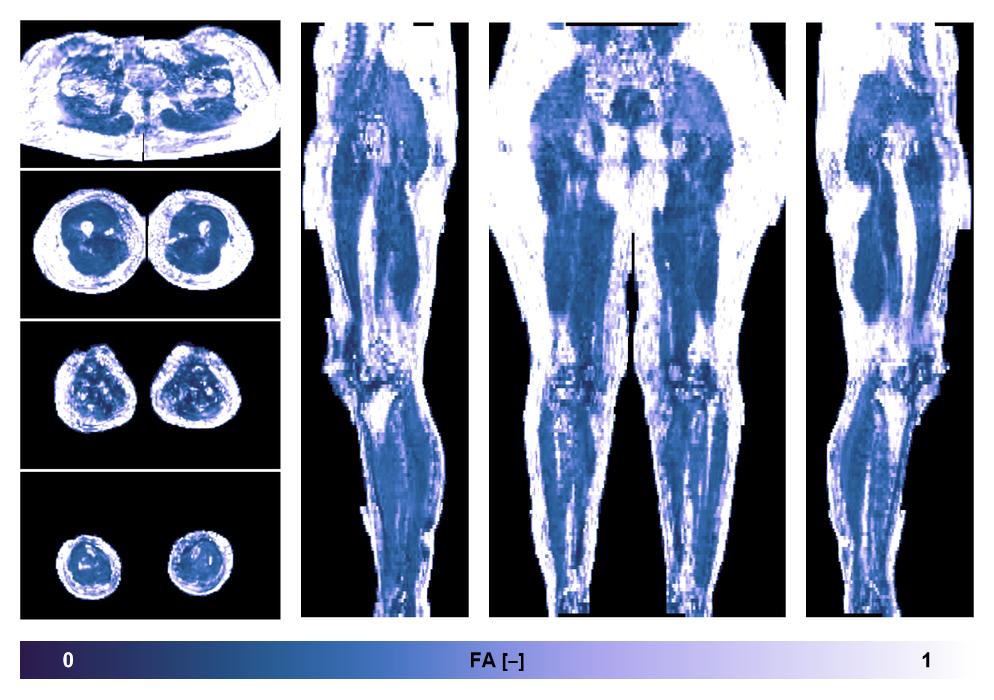 IVIM corrected whole leg muscle fractional anisotropy obtained from diffusion tensor imaging.
