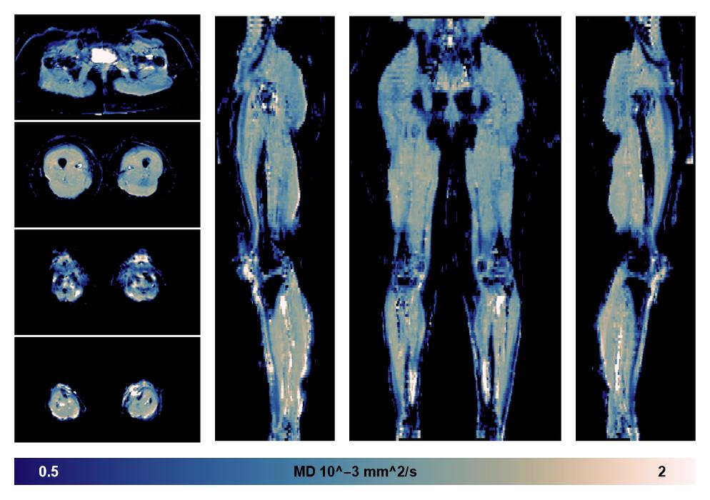 IVIM corrected whole leg muscle mean diffusivity obtained from diffusion tensor imaging.