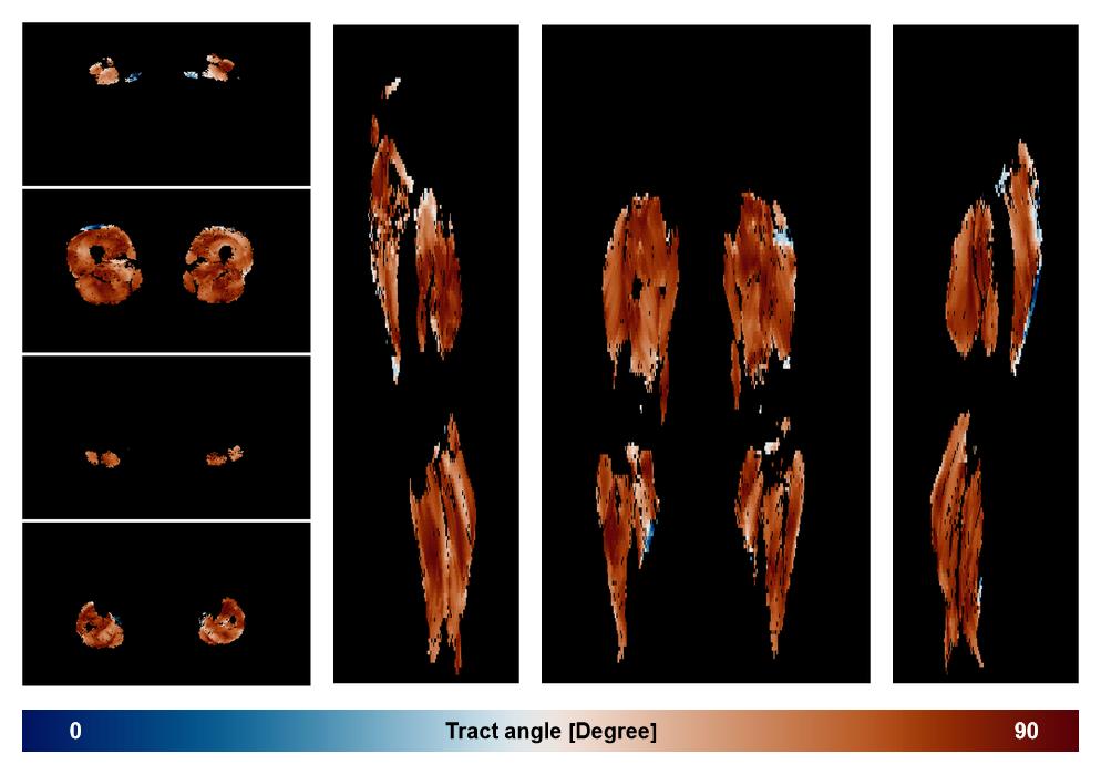 Muscle fiber tract angle map based on whole leg DTI based fiber tractography.